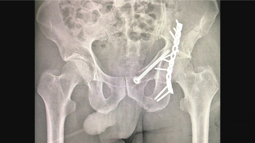 Fractura de pelvis